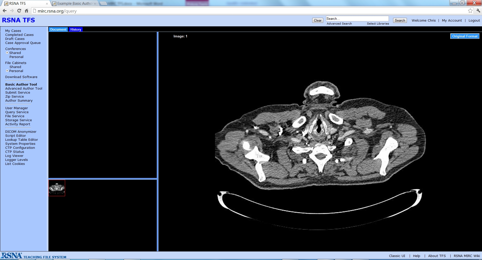 TFS basic case