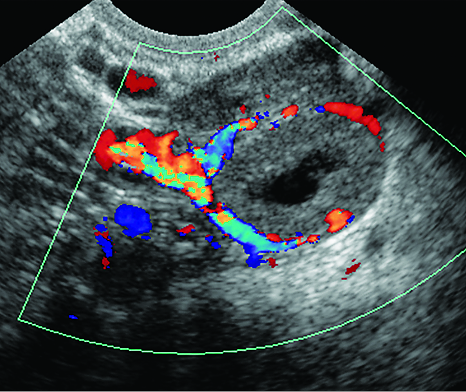 RadioGraphics October 2012 Langer figure 15b