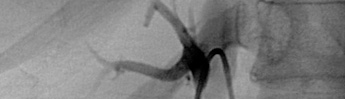 Technical Challenges Hinder Use of Adrenal Vein Sampling