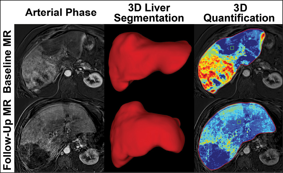 New-imaging-analysis-technique-provides-faster-treatment | RSNA