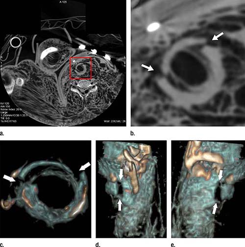 Post-mortem-ct-angiography-illuminates | RSNA