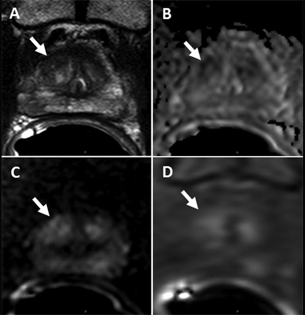 New Research Shows PI-RADS Version 2 Effective In Prostate Cancer ...