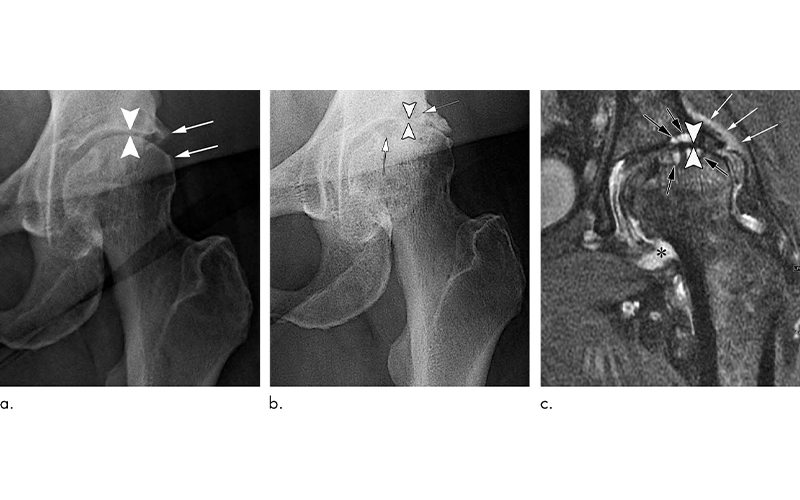 Steroid-Injections-Hip-Knee | RSNA