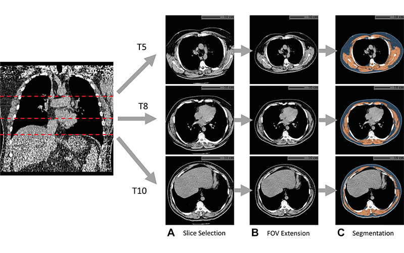 RSNA News | RSNA