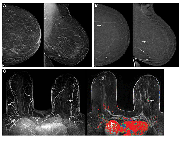 Images in a 67-year-old woman with triple receptor-negative invasive ductal carcinoma seen only at contrast-enhanced mammography at year 2
