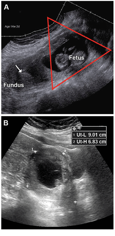 Kennedy Fig 13 Missed diagnosis of cesarean scar ectopic pregnancy