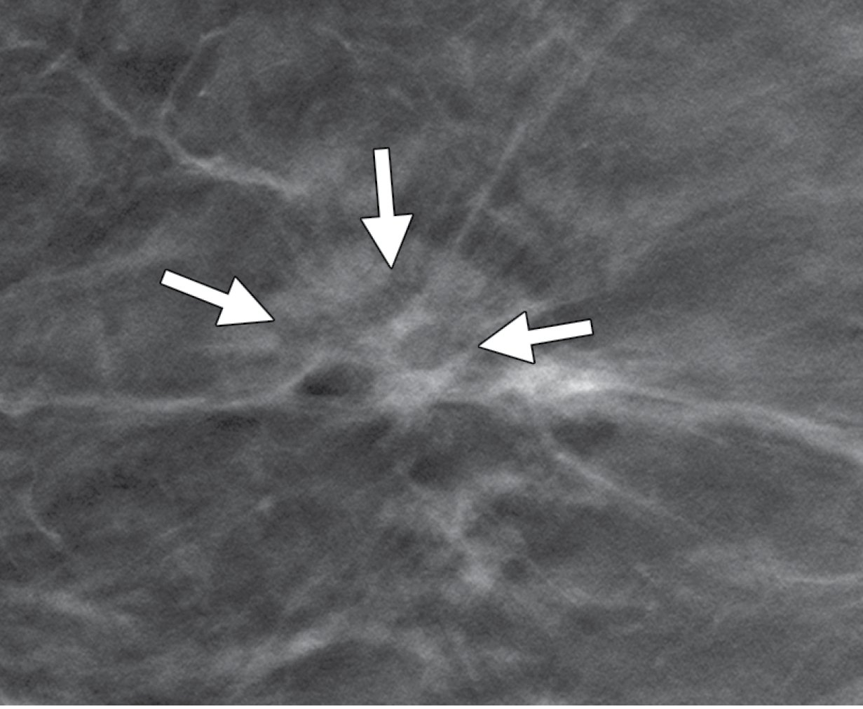 breast tomosynthesis a breast cancer screening tool breast tomosynthesis a breast cancer screening tool